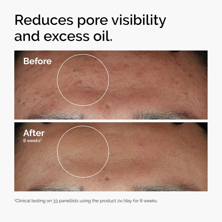 The Ordinary Niacinamide serum + Hyaluronic Acid